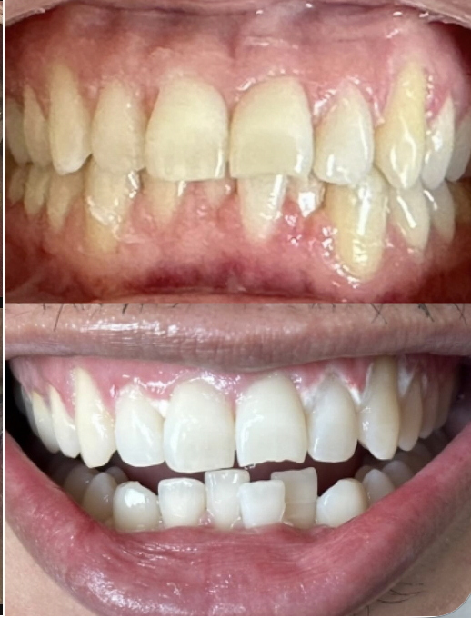 Before and after professional teeth whitening result 1 — Carte Blanche Los Angeles client
