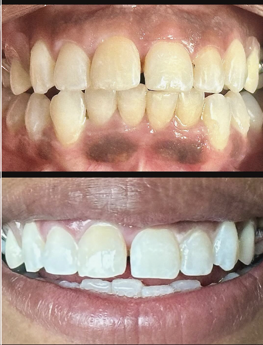 Before and after professional teeth whitening result 2 — Carte Blanche Los Angeles client