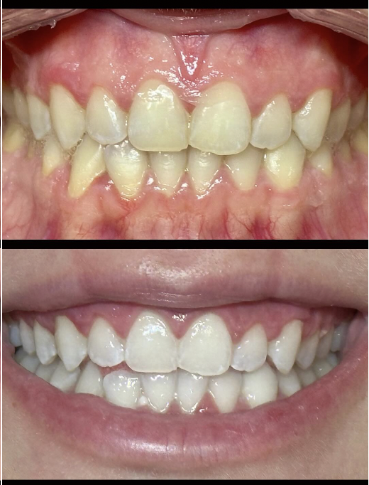 Before and after professional teeth whitening result 3 — Carte Blanche Los Angeles client